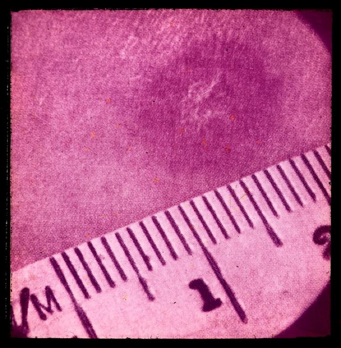 Santé publique: lutte contre la tuberculose, acte médical, vaccination.