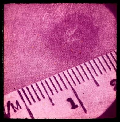 Santé publique: lutte contre la tuberculose, acte médical, vaccination.