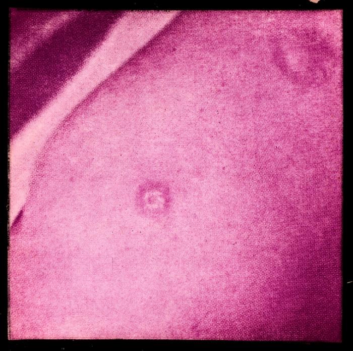 Santé publique: lutte contre la tuberculose, acte médical, vaccination.