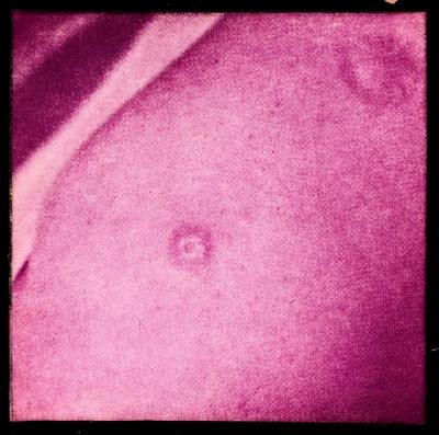 Santé publique: lutte contre la tuberculose, acte médical, vaccination.