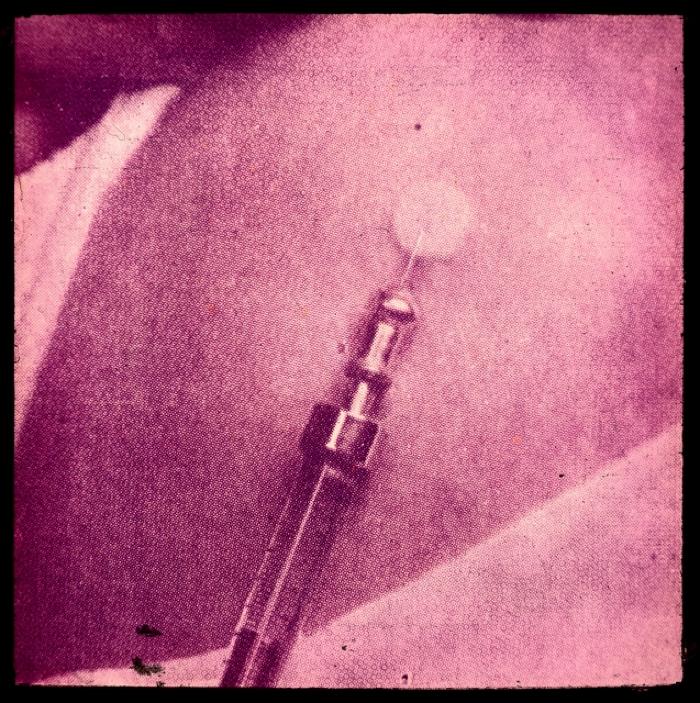 Santé publique: lutte contre la tuberculose, acte médical, vaccination.