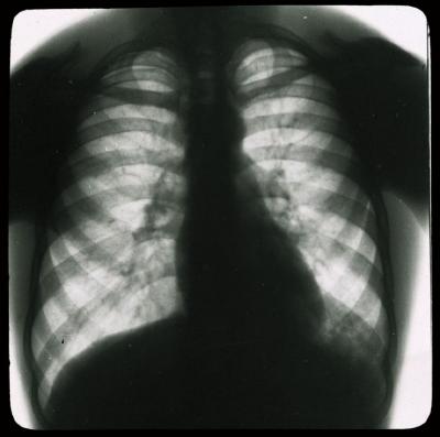 Document médical, radiographie de poumons d'hommes.