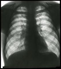 Document médical, radiographie de poumons non identifiés.
