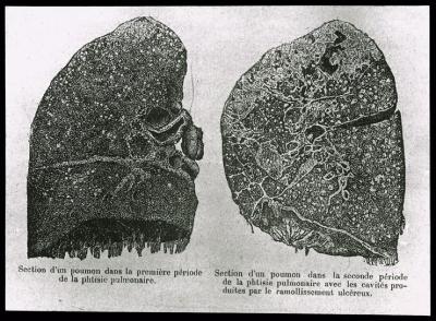 Document médical, dessin de poumons représentant les différentes étapes de la tuberculose/phtisie pulmonaire.