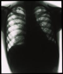 Document médical, radiographie de poumons d'enfant.