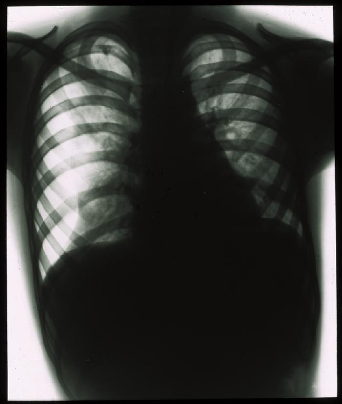 Document médical, radiographie de poumons d'enfant.
