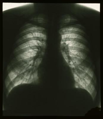 Document médical, radiographie de poumons sains.