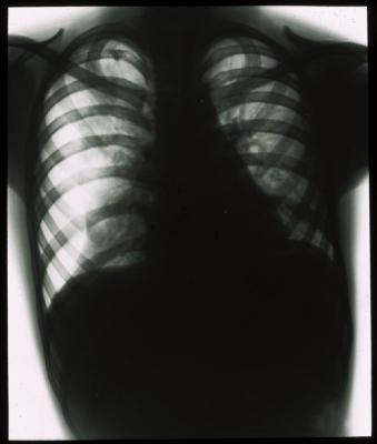 Document médical, radiographie de poumons d'enfant.