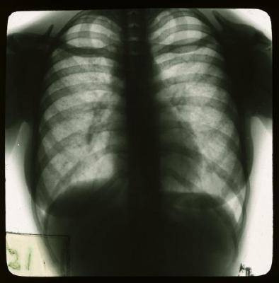 Document médical, radiographie de poumons de femme.