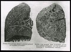 Document médical, dessin de poumons représentant les différentes étapes de la tuberculose/phtisie pulmonaire.