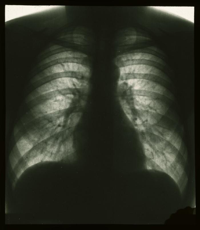 Document médical, radiographie de poumons sains.