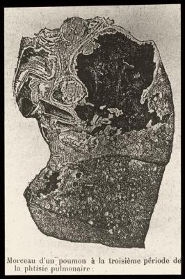 Document médical, dessin de poumons représentant les différentes étapes de la tuberculose/phtisie pulmonaire.