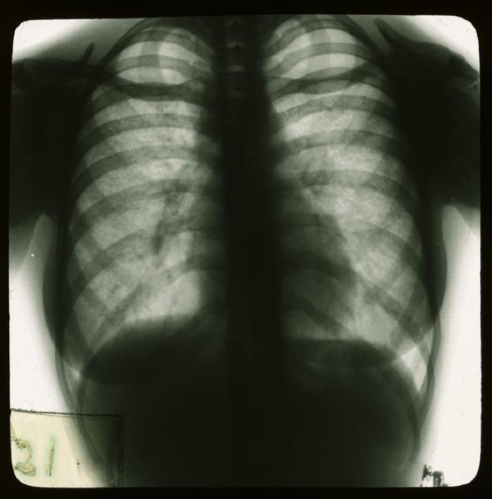 Document médical, radiographie de poumons de femme.