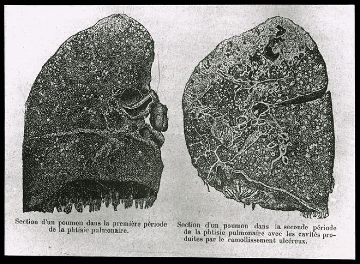 Document médical, dessin de poumons représentant les différentes étapes de la tuberculose/phtisie pulmonaire.