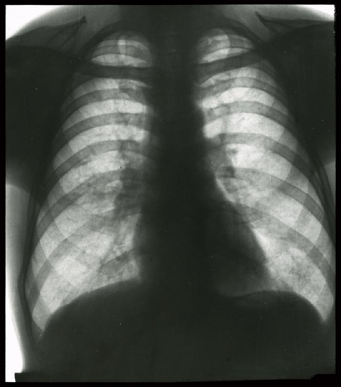 Document médical, radiographie de poumons non identifiés.