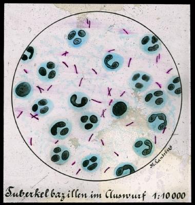 Document médical, image du bacille de Koch.