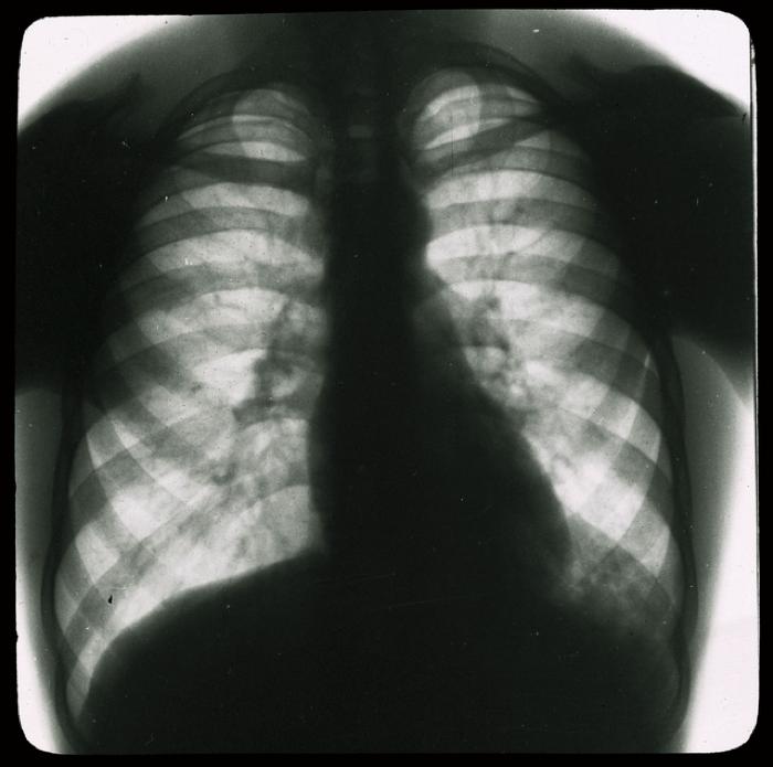 Document médical, radiographie de poumons d'hommes.
